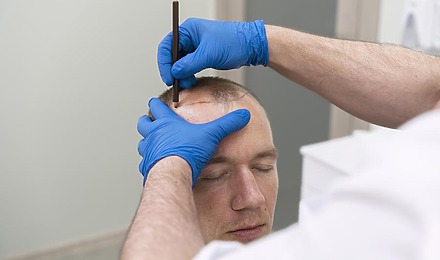 How Long Does A Hair Transplant Take - Featured Image By Freepik