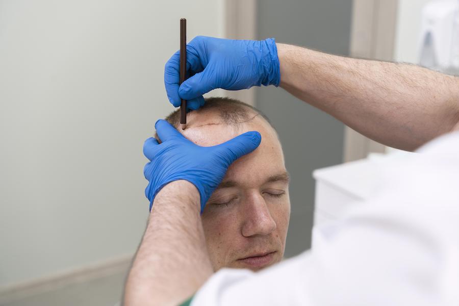 How Long Does A Hair Transplant Take Wimpole Clinic