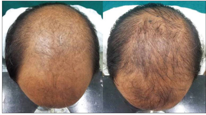 norwood 6 patient before and after finasteride