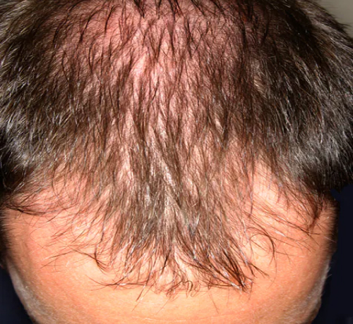 Hair loss in a man