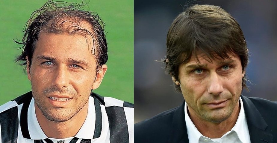 Antonio Conte before and after hair restoration