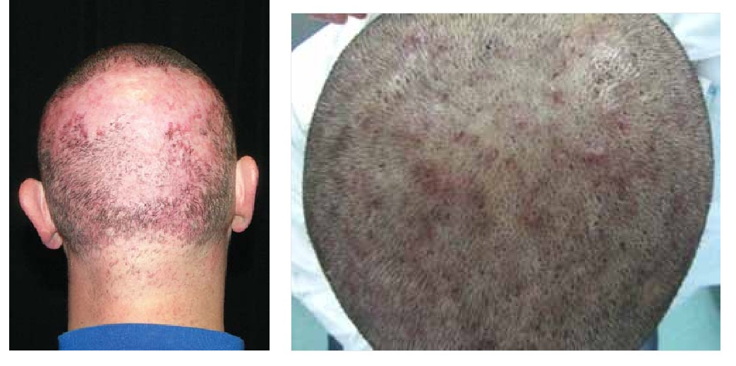 individuals with folliculitis on the scalp