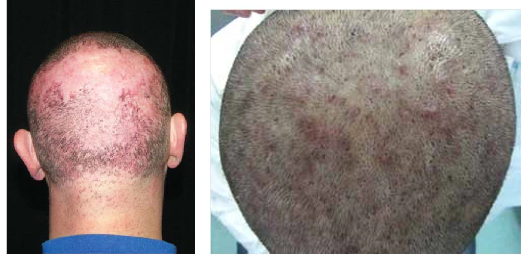 Individuals with folliculitis on the scalp