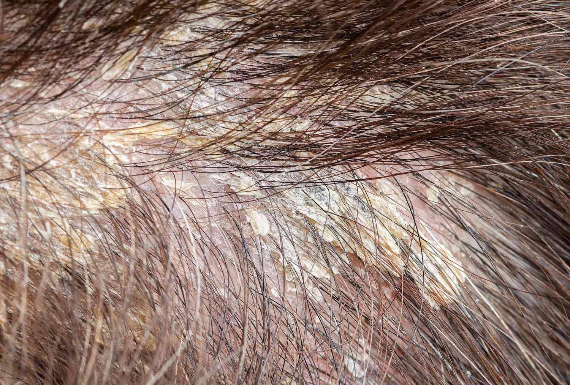 infected scalp