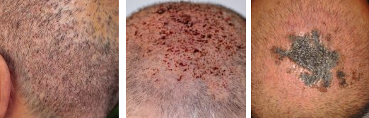 Examples of infected hair transplant in donor and recipient sites