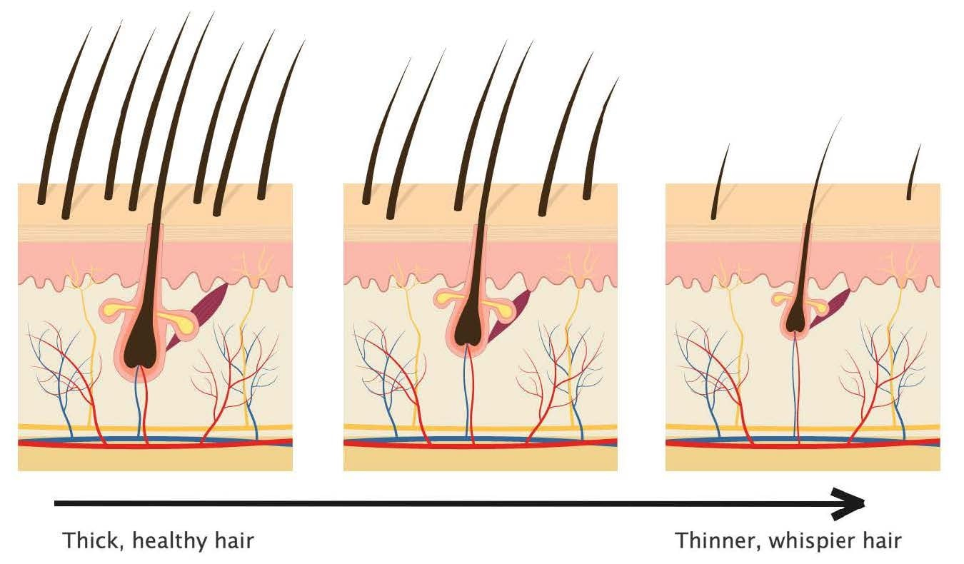 informational graphic showing how hair gets thinner overtime