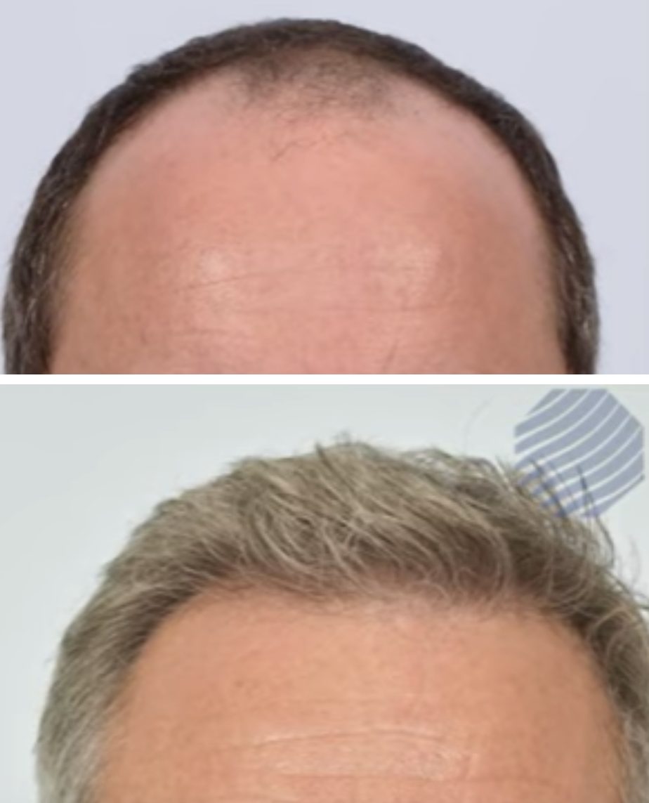 James Nesbitt before and after hair transplant