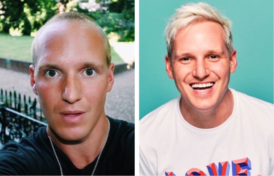 Jamie Laing before and after hair transplant