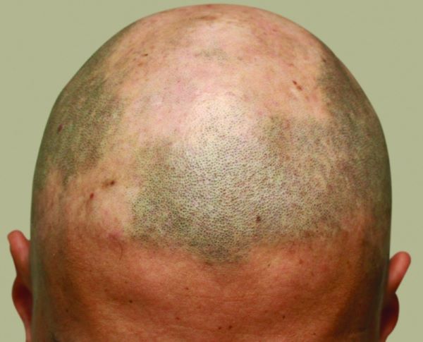 alopecia patient before SMP scalp micropigmentation