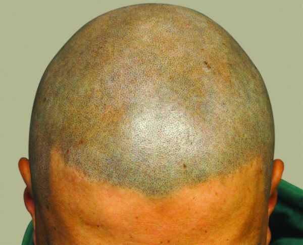 alopecia patient after SMP scalp micropigmentation