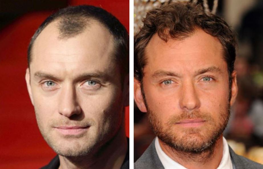 Jude Law before and after rumoured hair transplant