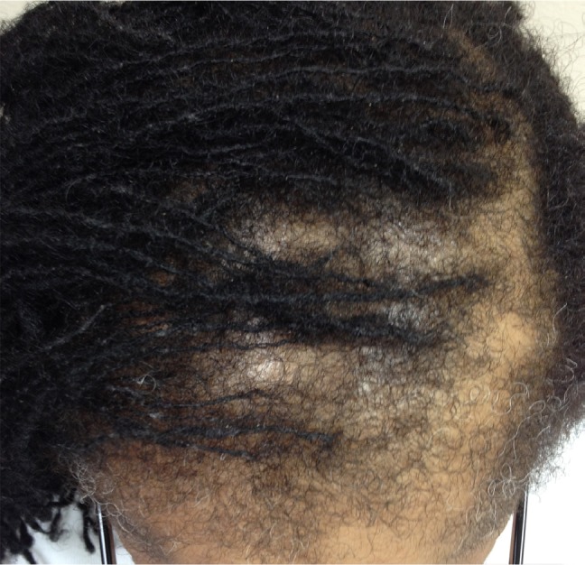 later traction alopecia patient