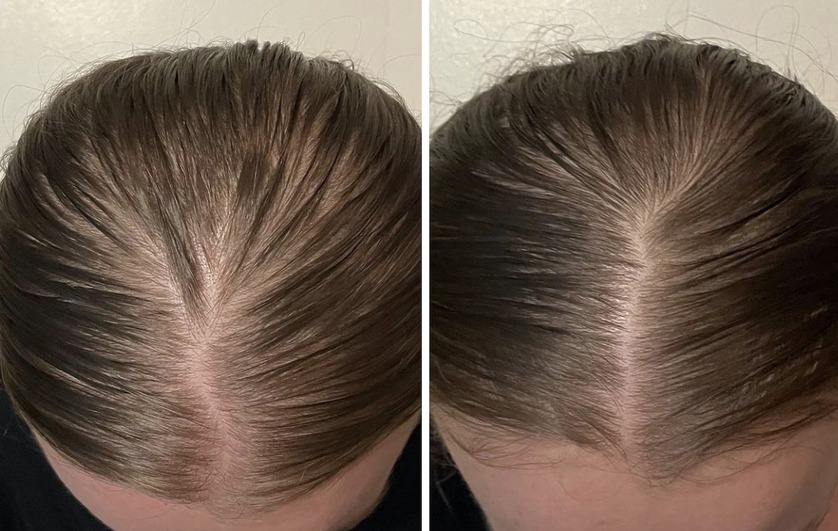 How Do I Apply Minoxidil Wimpole Clinic How Do I Apply Minoxidil Wimpole Clinic
