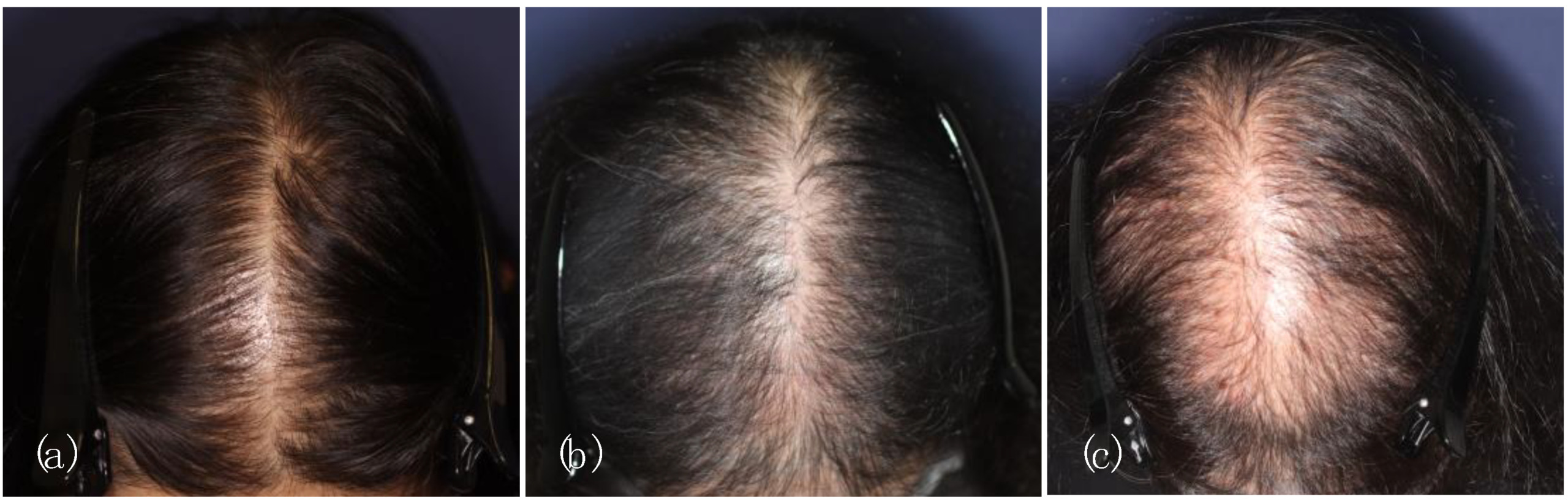PDF] A new classification of pattern hair loss that is universal for men  and women: basic and specific (BASP) classification. | Semantic Scholar
