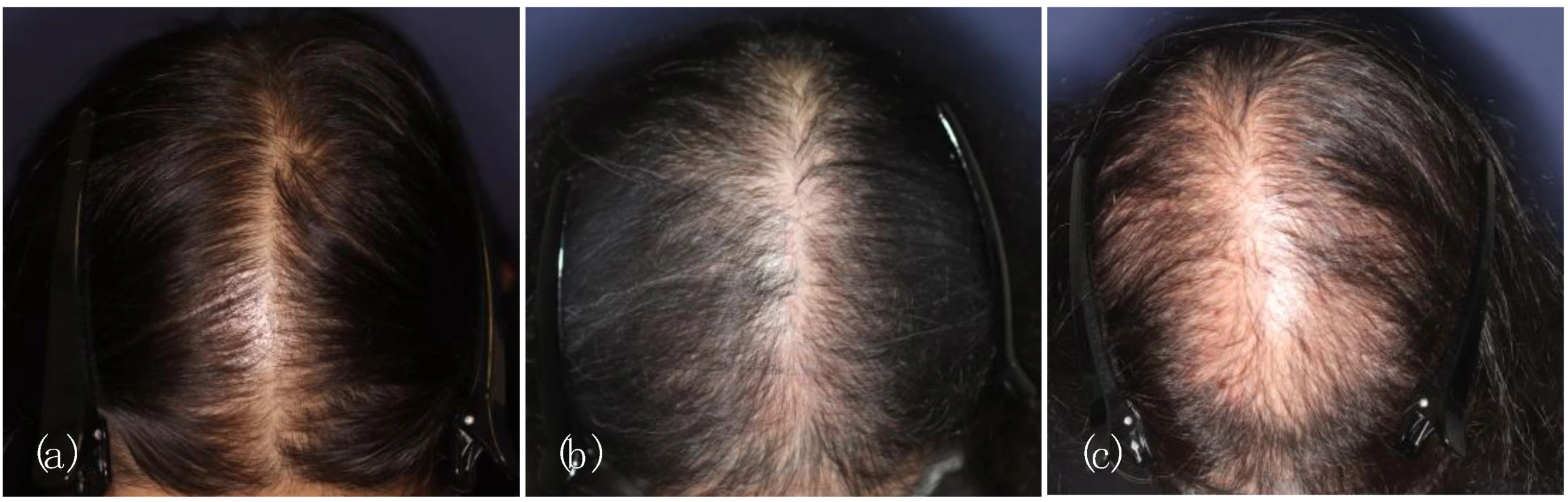 Female pattern baldness