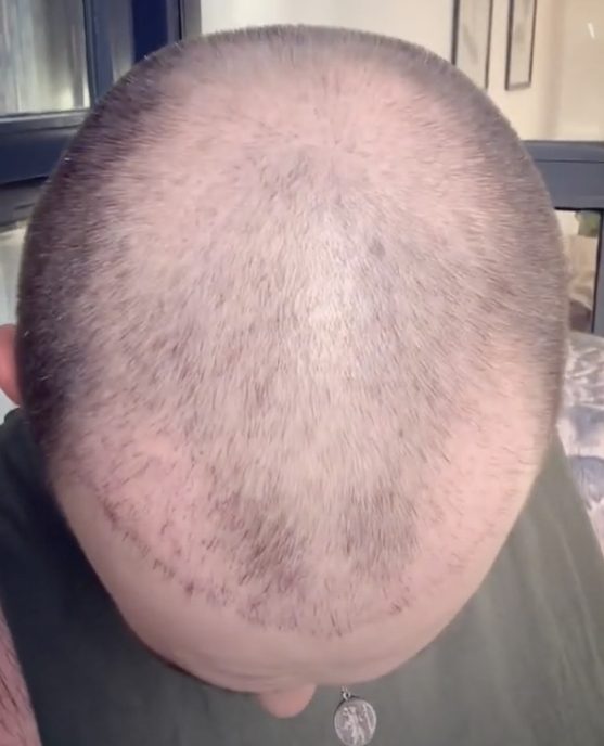 m shaped hairline 2 months after hair transplant