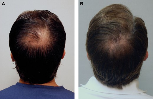 pre hair transplants and results 8 months after surgery