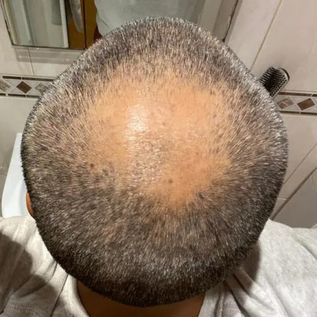 male pattern baldness on the back of head