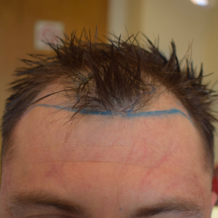 male pattern baldness at the hairline