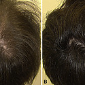 Minoxidil Before And After: Photos & Results