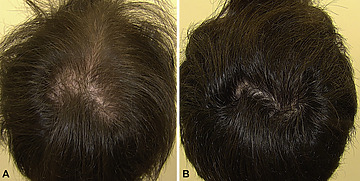 Minoxidil Before And After: Photos & Results Clinic