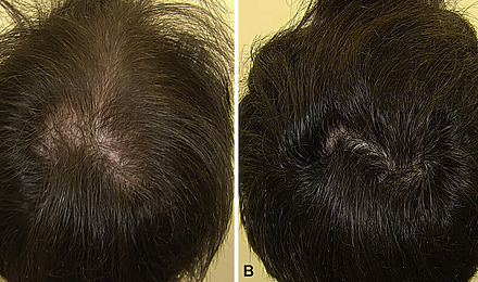Minoxidil Before And After Featured Image