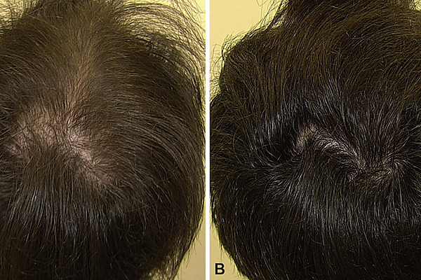 Male Pattern Baldness Oral Minoxidil Before And After
