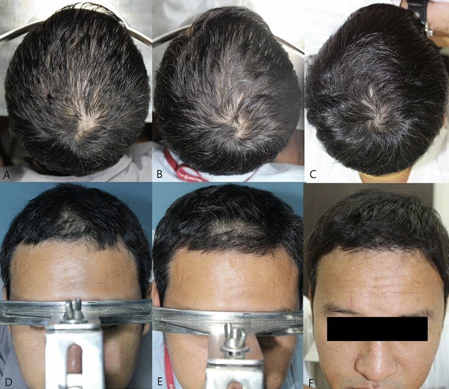 male pattern hair loss before and after minoxidil treatment - patient 1
