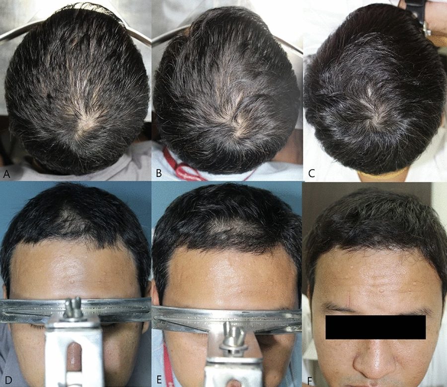 Before and after hair growth results of using Minoxidil for male pattern hair loss