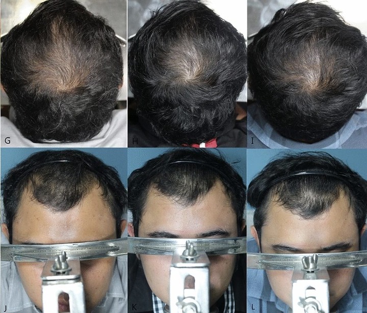 Minoxidil Before And After Photos & Results Wimpole Clinic