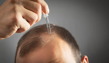 man applying substance to his receding hairline
