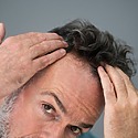 Why Do Hair Transplants Fail?