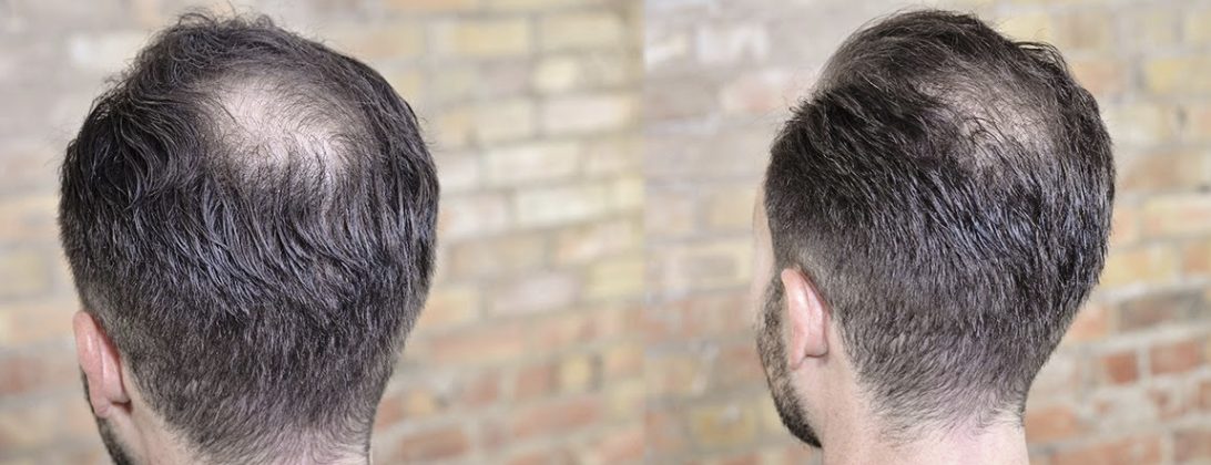 man styling his hair to cover up bald spot