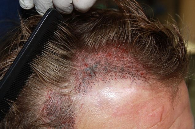 Michael Gray post hair transplant scabbing