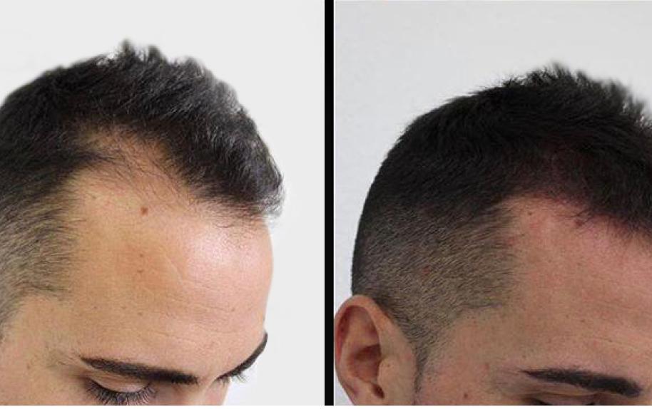 before and after micro-pigmentation photos