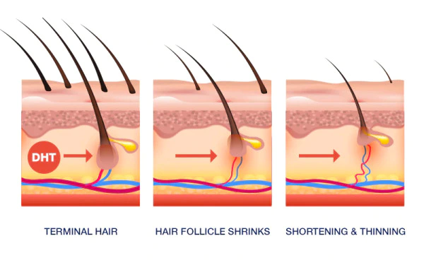 Informational graphic showing how hair follicles shrink over time due to DHT exposure and stop producing hair