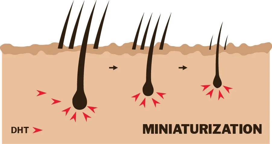 miniaturization of hair follicles