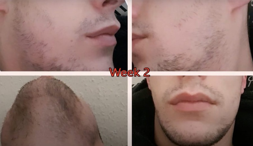 Minoxidil Beard Growth Before And After Wimpole Clinic