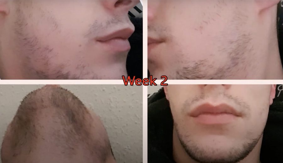 minoxidil beard growth week 2