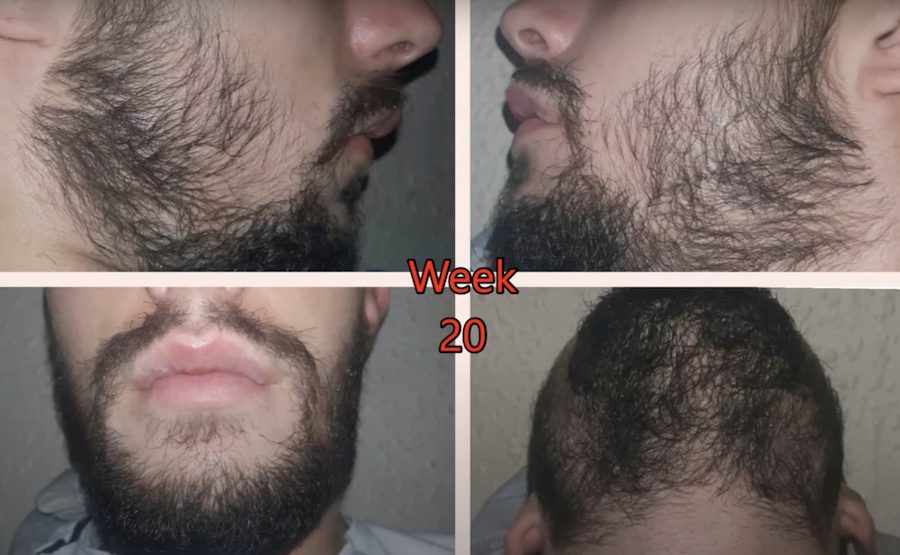 Minoxidil beard growth week 20