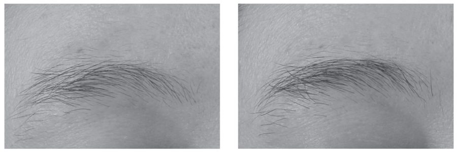minoxidil on eyebrows before and after