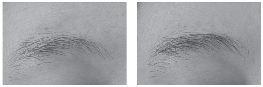 Before and after using Minoxidil to regrow eyebrow hair