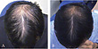What Happens When You Stop Using Minoxidil? - Wimpole Clinic