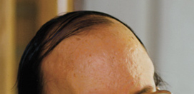 Example of Myotonic Dystrophy Frontal balding