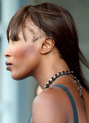 naomi campbell traction alopecia leading to temple hair loss