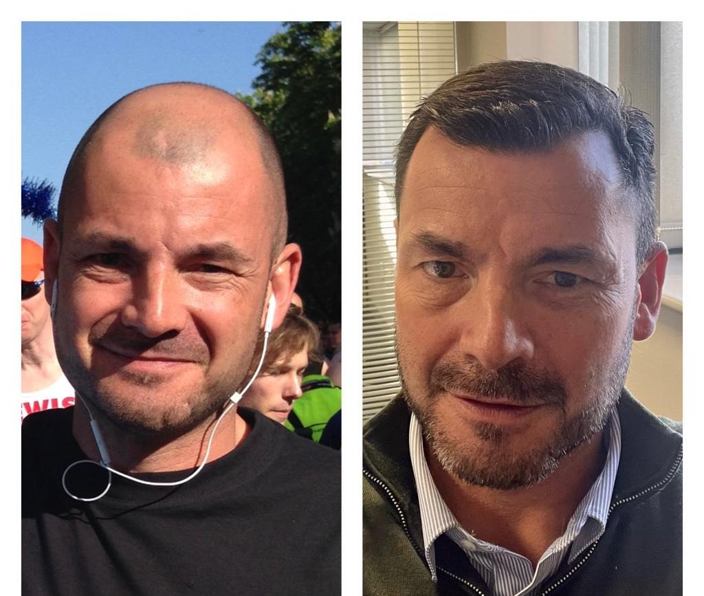 FUT and FUE hair transplants before and after photos