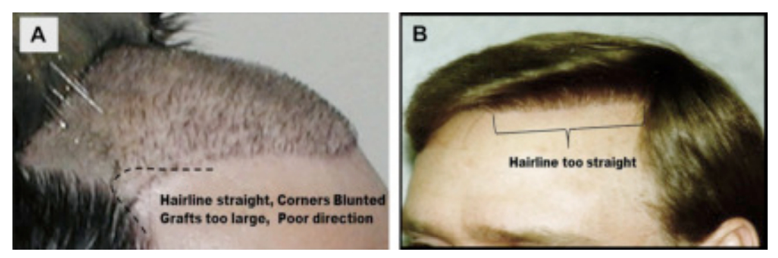 Examples of poor hairline designs