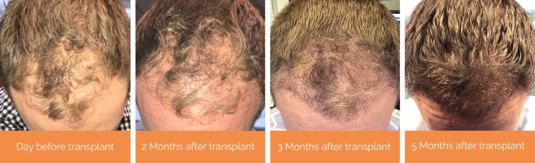 photo examples showing the growth of a hair transplant over months