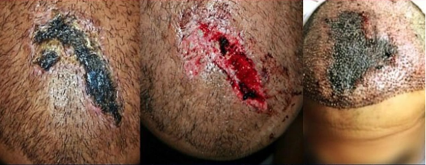 Scalp necrosis in hair transplant patients