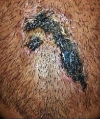 Necrosis due to an infected hair transplant